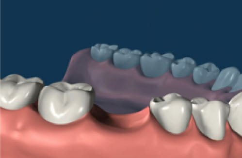 dental implant 01