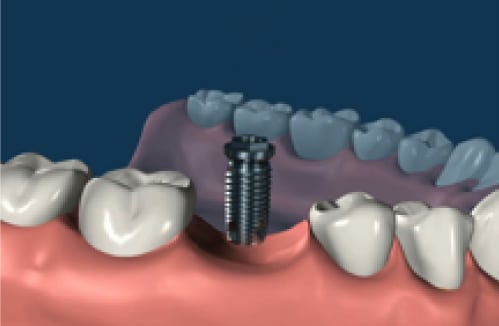 dental implant 02