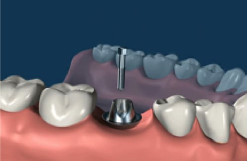 dental implant 03