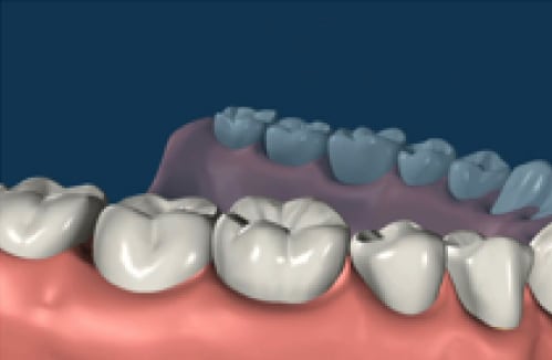 dental implant 04